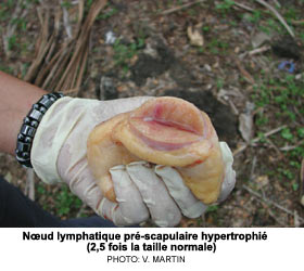 Nud lymphatique pr-scapulaire hypertrophi (2,5 fois la taille normale)
